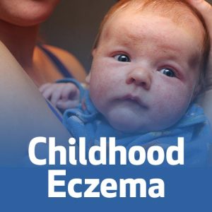 Como Tratar Eczemas Comuns Na Infância