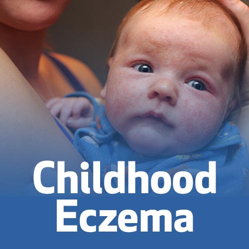 Como Tratar Eczemas Comuns Na Infância